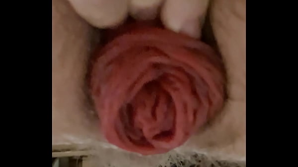 Anal Fisting Broken Asshole thumbnail