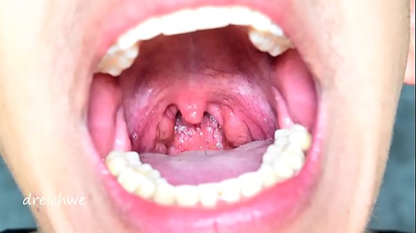 Uvula In The Foreground - Collection 12 thumbnail