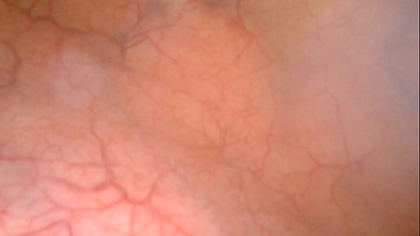 A view of my bladder full of piss with endoscopy. 
