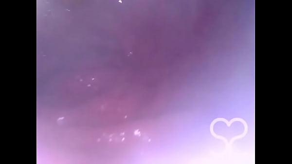 Anal Endoscope all the way in my Transverse Colon!