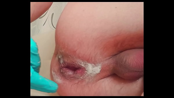 handsome skinny twink with ruptured prolapse makes fisting to himself