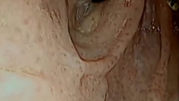 In Loop Inside My Troath With Endoscope - Loop Video Asmr - Hardcore Medical Fetish thumbnail