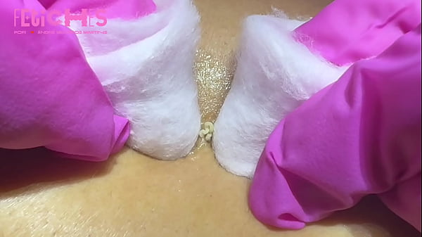 Extra&ccedil_&atilde_o de cravos e espinhas