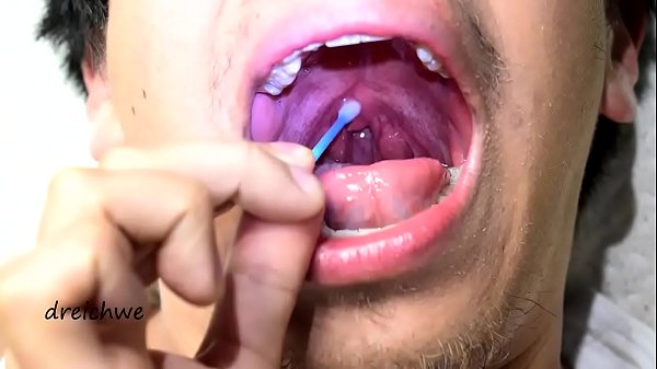 Touching The Uvula With Swabs thumbnail