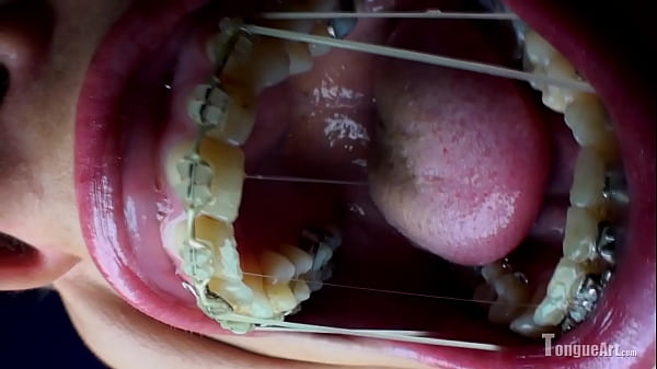 Pixie Opens Mouth Shows Dental Work thumbnail