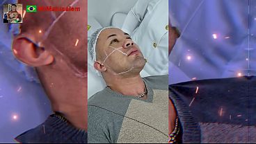 Motiva&ccedil;&atilde;o Me transformei com a harmoniza&ccedil;&atilde;o facial veja o resultado 