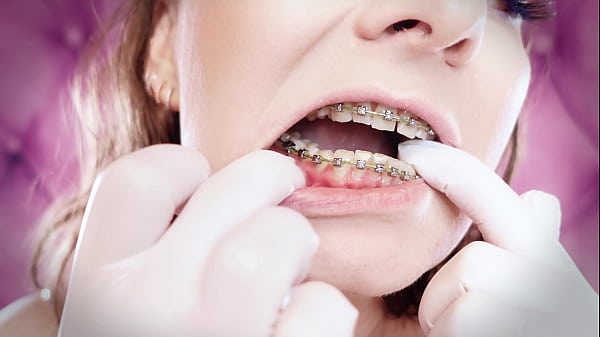 ASMR upgraded_braces with chain link rubber bands and_nitrile_gloves