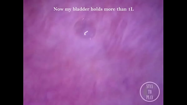 POV Endoscope Catheter Bladder Inflation!