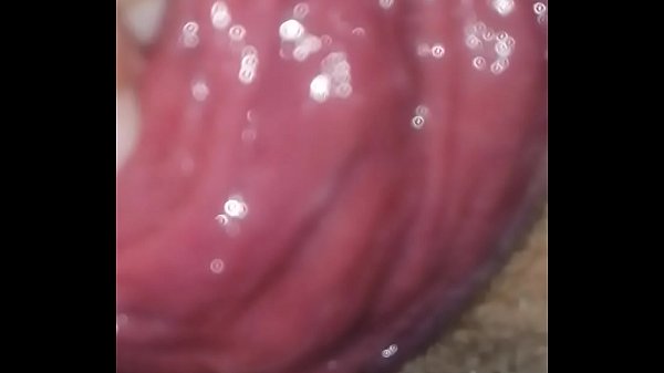 Play MP4 - Anal prolapse