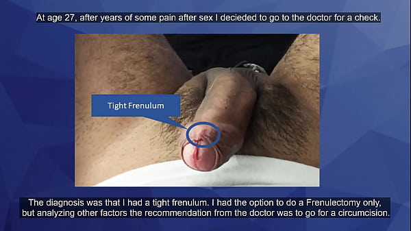 Circumcision_Check this out