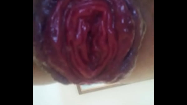 Play MP4 - Anal prolapso