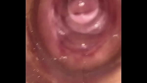 Deep cervix