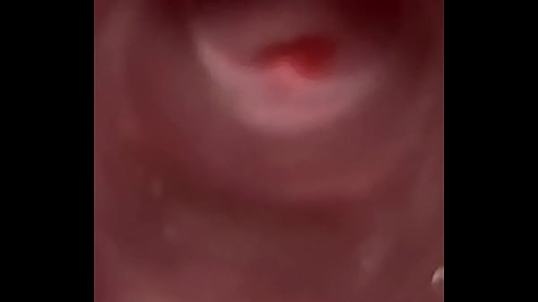 Deep cervix