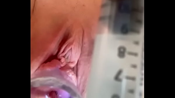 as cervixpainfully dilated w catheter