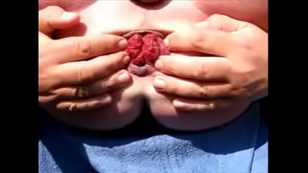 Ass Gape Extreme MonsterExtrem Prolapse Asshole
